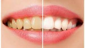 Diş Beyazlatma Tedavisi Nedir ?