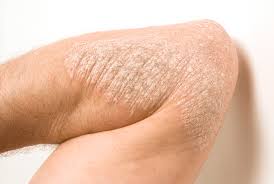 SEDEF HASTALARI RAMAZANDA NASIL BESLENMELİ