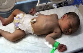 HER YIL 1 MİLYON BEBEK ERKEN DOĞUM NEDENİYLE HAYATINI KAYBEDİYOR